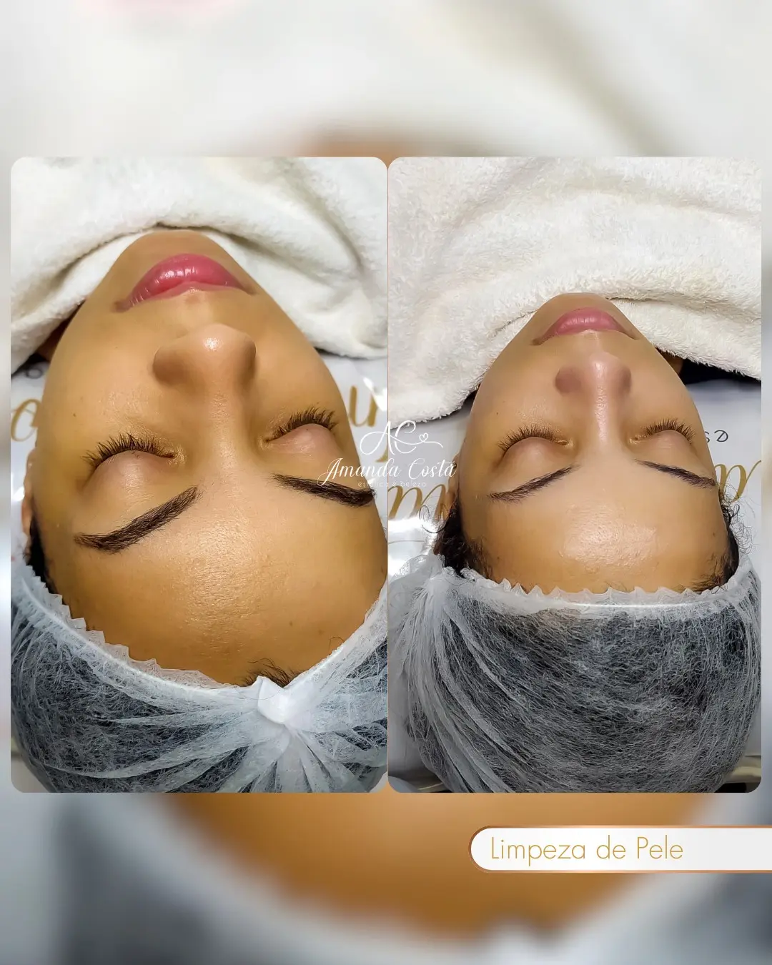 Resultado de limpeza de pele divulgado pela AC Estética